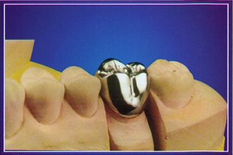 产品展示 义齿产品  纯钛钢牙 用纯钛金属制作内冠 特性